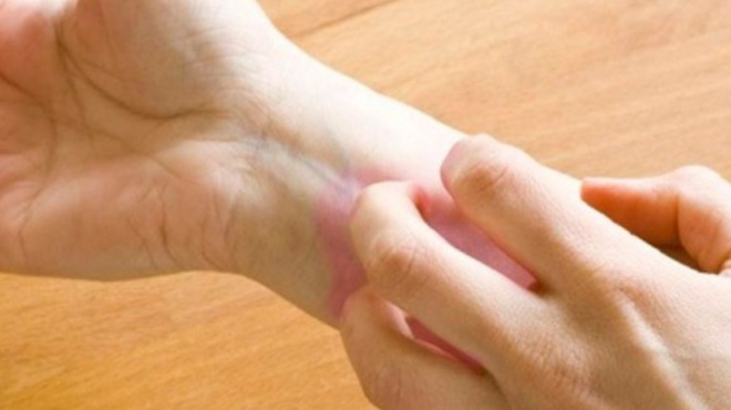 τα-σπυράκια-στα-χέρια-που-δείχνουν-ό-68114