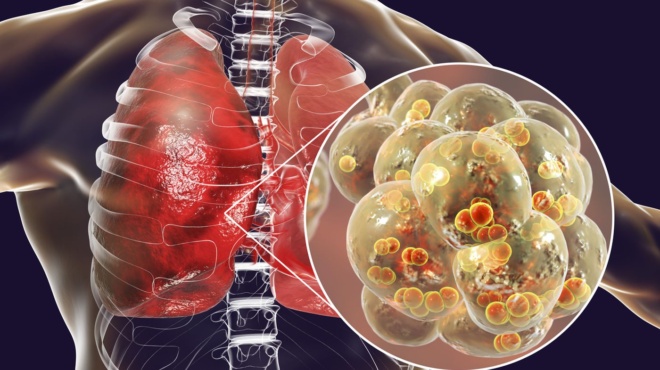 καμπανάκι-για-τον-καρκίνο-στους-30ρη-67226