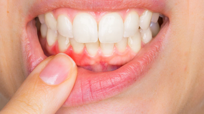 ματώνουν-συχνά-τα-ούλα-σας-για-ποιες-4-ν-65151